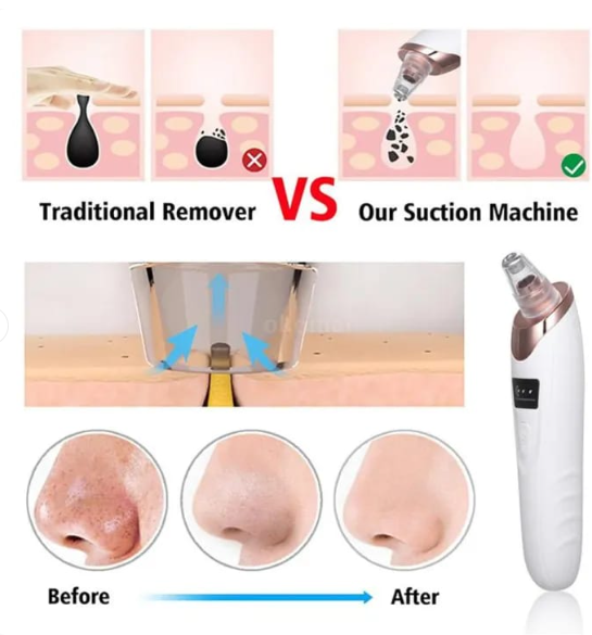 Face Vacuum Suction Blackhead Remover – Electric Pore Cleaner for Nose & Face Deep Cleansing